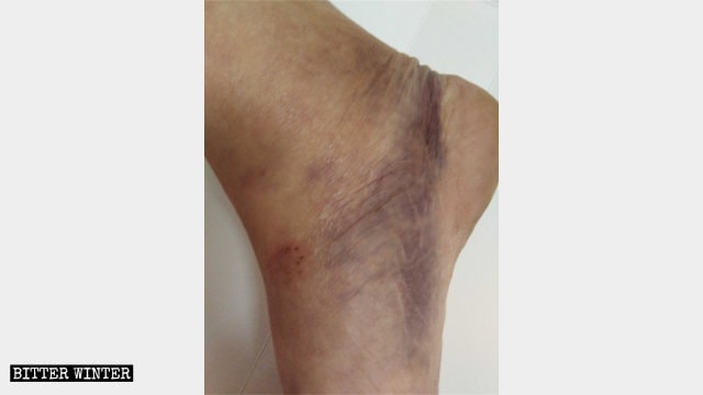 Wei Lihui’s injured foot